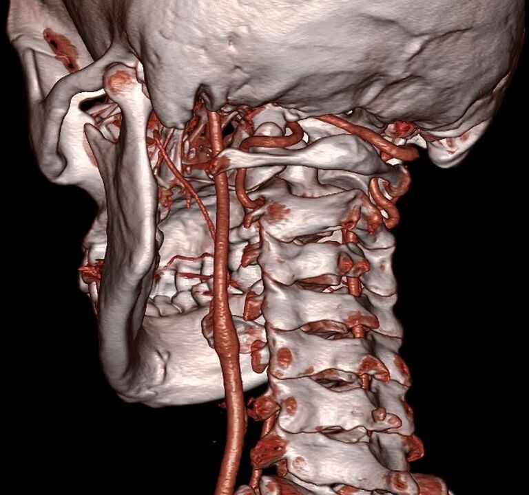 csípő artéria nyaki osteochondrosisban