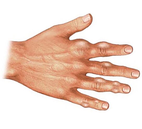 Húgysavkristályok lerakódása az ujjak lágy szöveteiben köszvényes ízületi gyulladás esetén