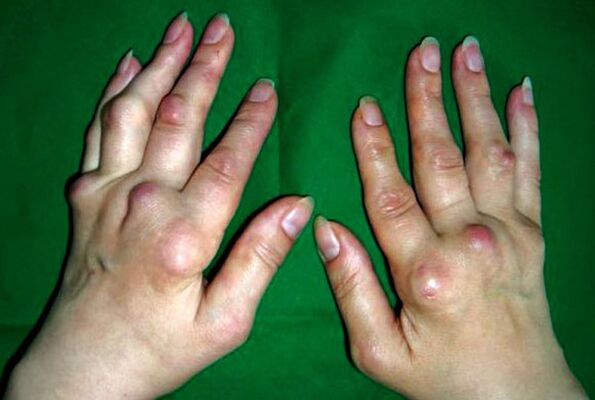 Polyosteoarthritis deformans által érintett kezek