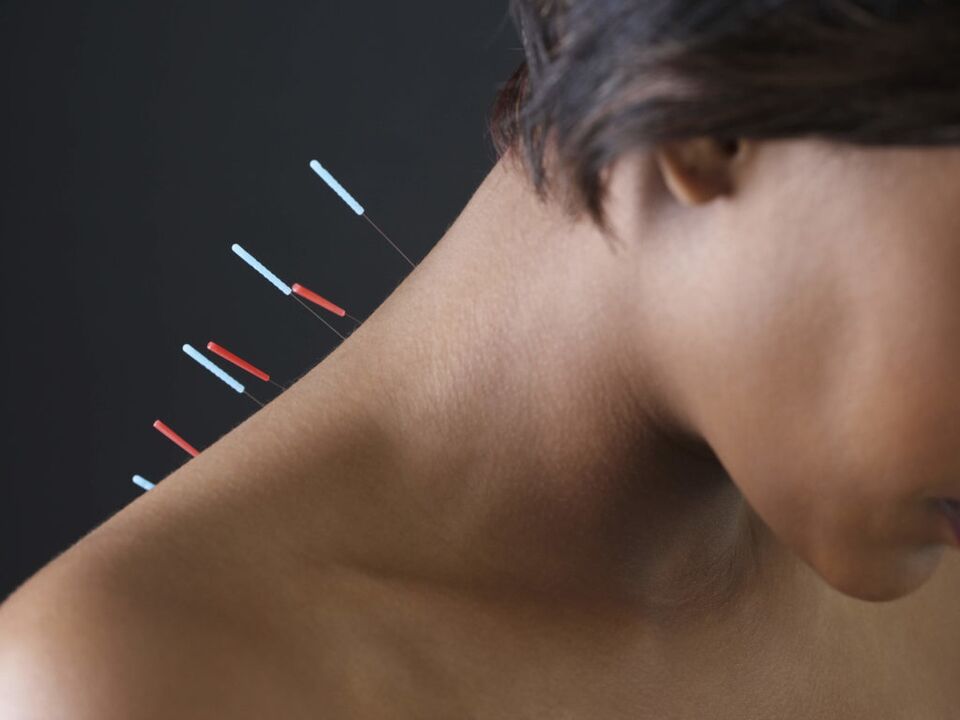 A nyaki osteochondrosis akupunktúrája kiküszöböli a gyulladásos folyamatokat